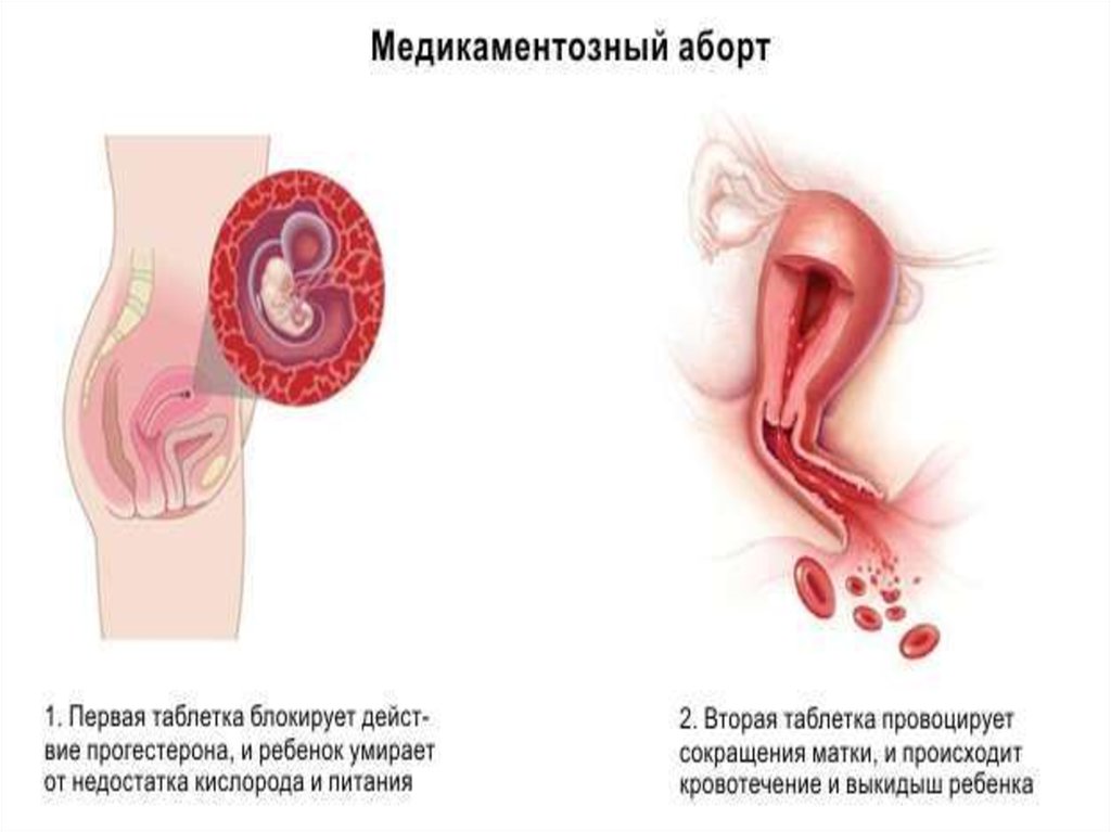 Медикаментозный способ прерывания беременности до какой недели