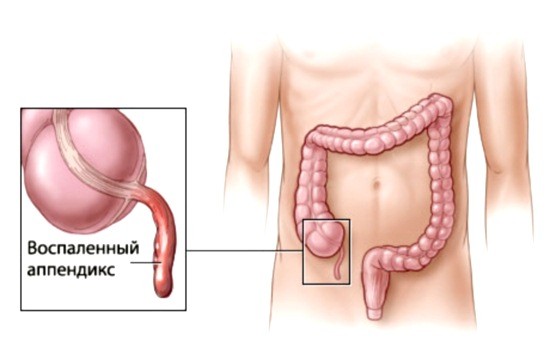 Воспаленный аппендикс