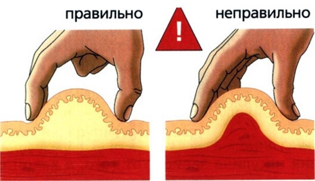 Сбор складки кожи для инъекции