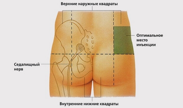 Оптимальное место для инъекции в ягодицу