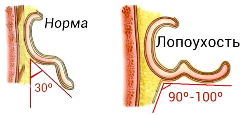 Как сделать чтобы уши разложило