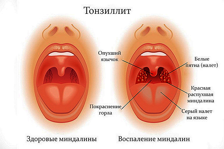 Гнойный тонзиллит