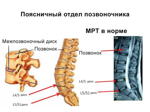 МРТ здорового позвоночника