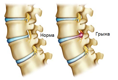 Грыжа пояснично-крестцового отдела
