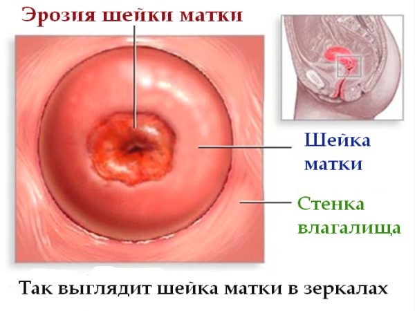 Польза Гексикона для лечения эрозии шейки матки