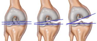 травмы коленного сустава