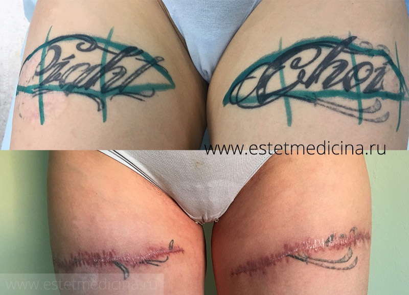 удаление татуировки операция