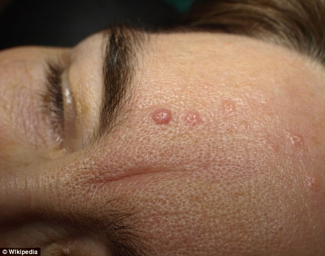 Seborrheic keratoses are light brown or almost black, flat or warty, sometimes like a cauliflower in texture and tend to commonly appear on people’s trunks, scalps and faces, though they can turn up anywhere