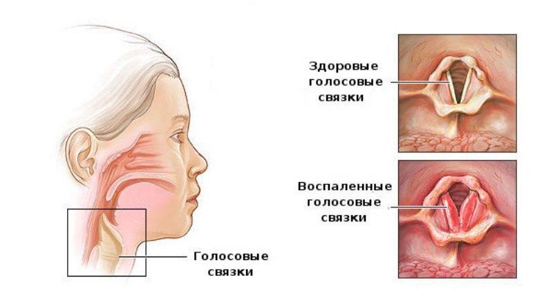 Ларингит