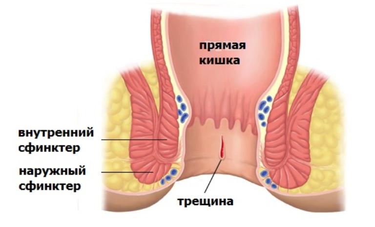 Трещина в анальном отверстии