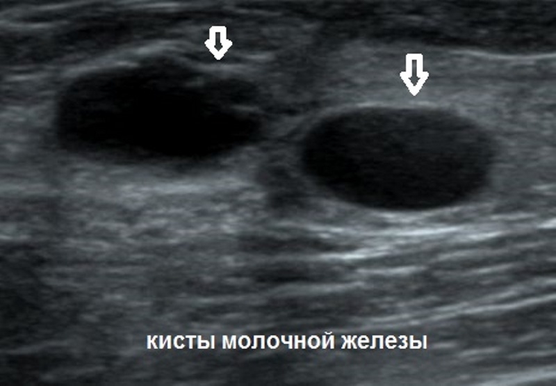 киста молочной железы