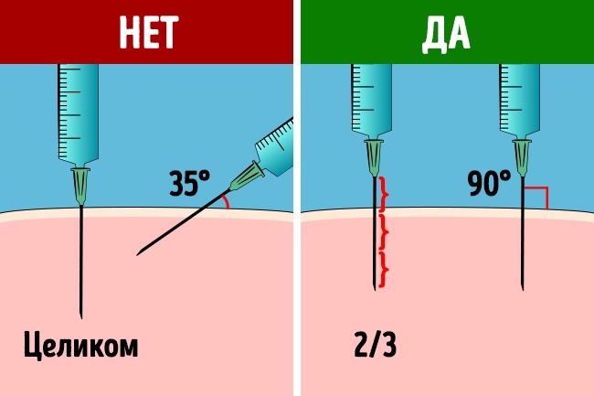 Иглу вводят перпендикулярно мышце