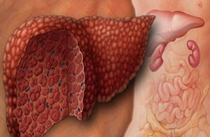 рисунок как выглядит печень после гепатита B