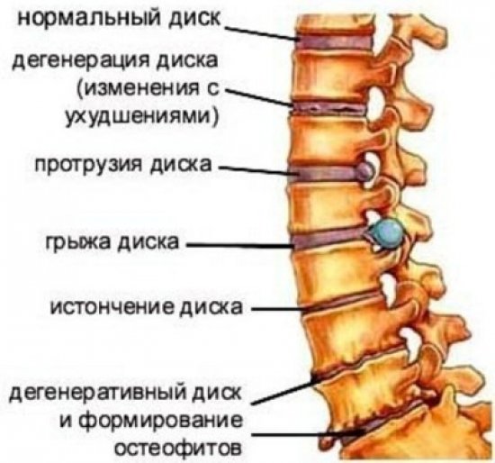 Патологии позвоночника