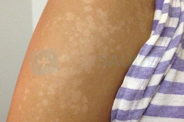 White spots caused by sun exposure