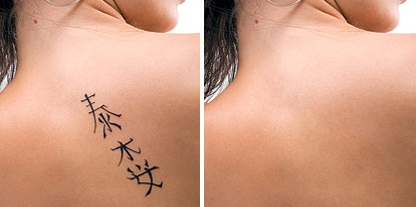удаление татуировки без шрамов