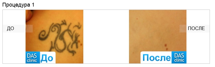 фото удаления татуировки до и после